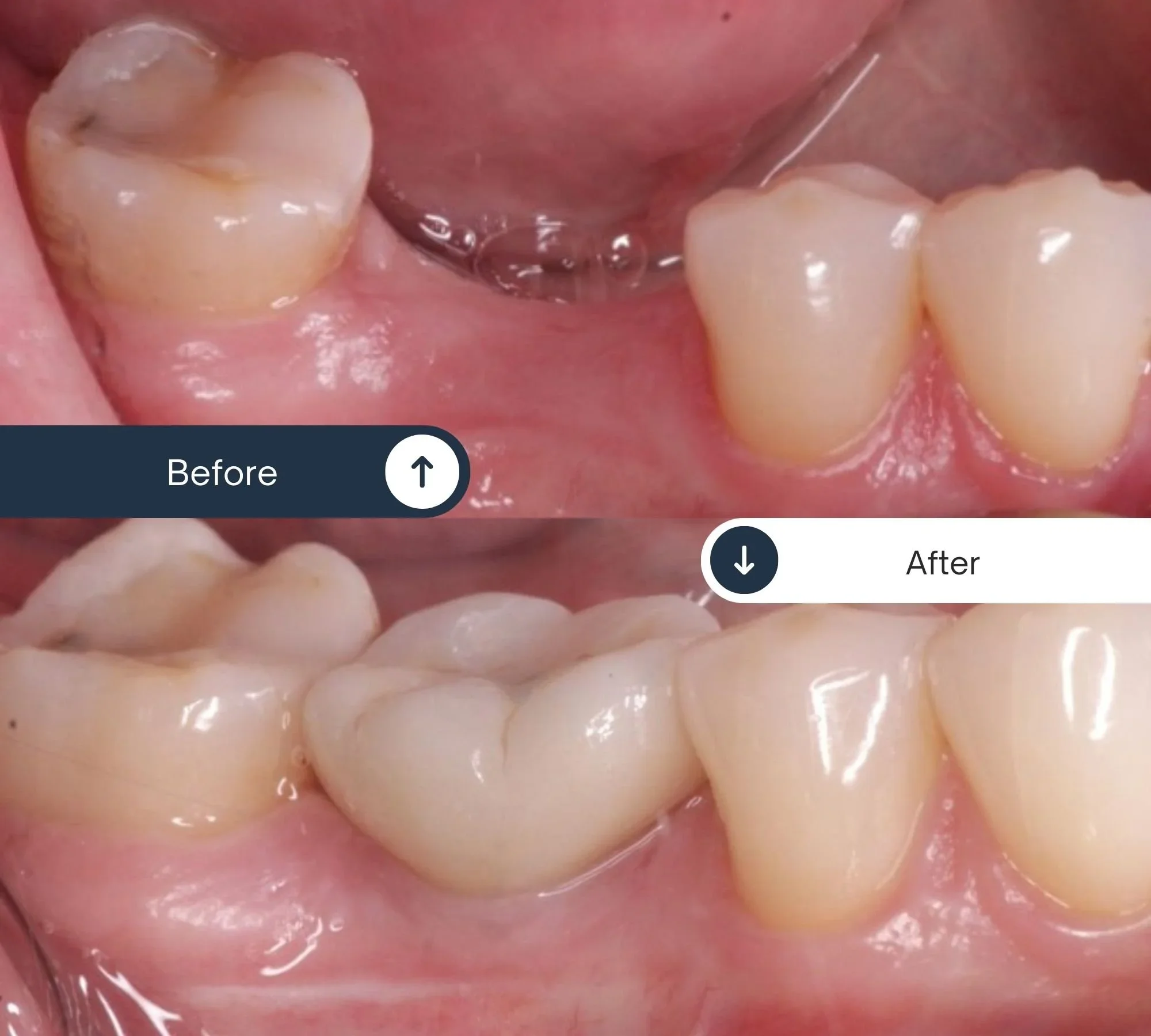 Can You Get Dental Implants If You Have Gum Disease?