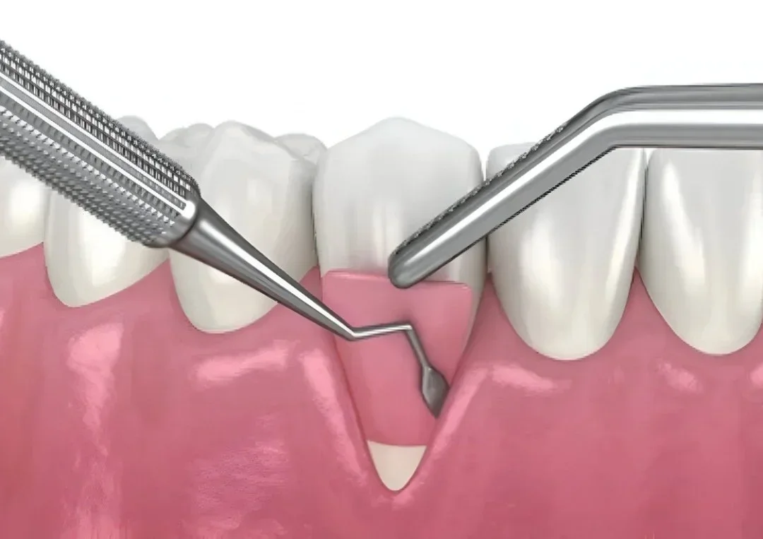 Should You Choose Implants or Bridges If You Have Bone Loss? A Science-Backed Guide