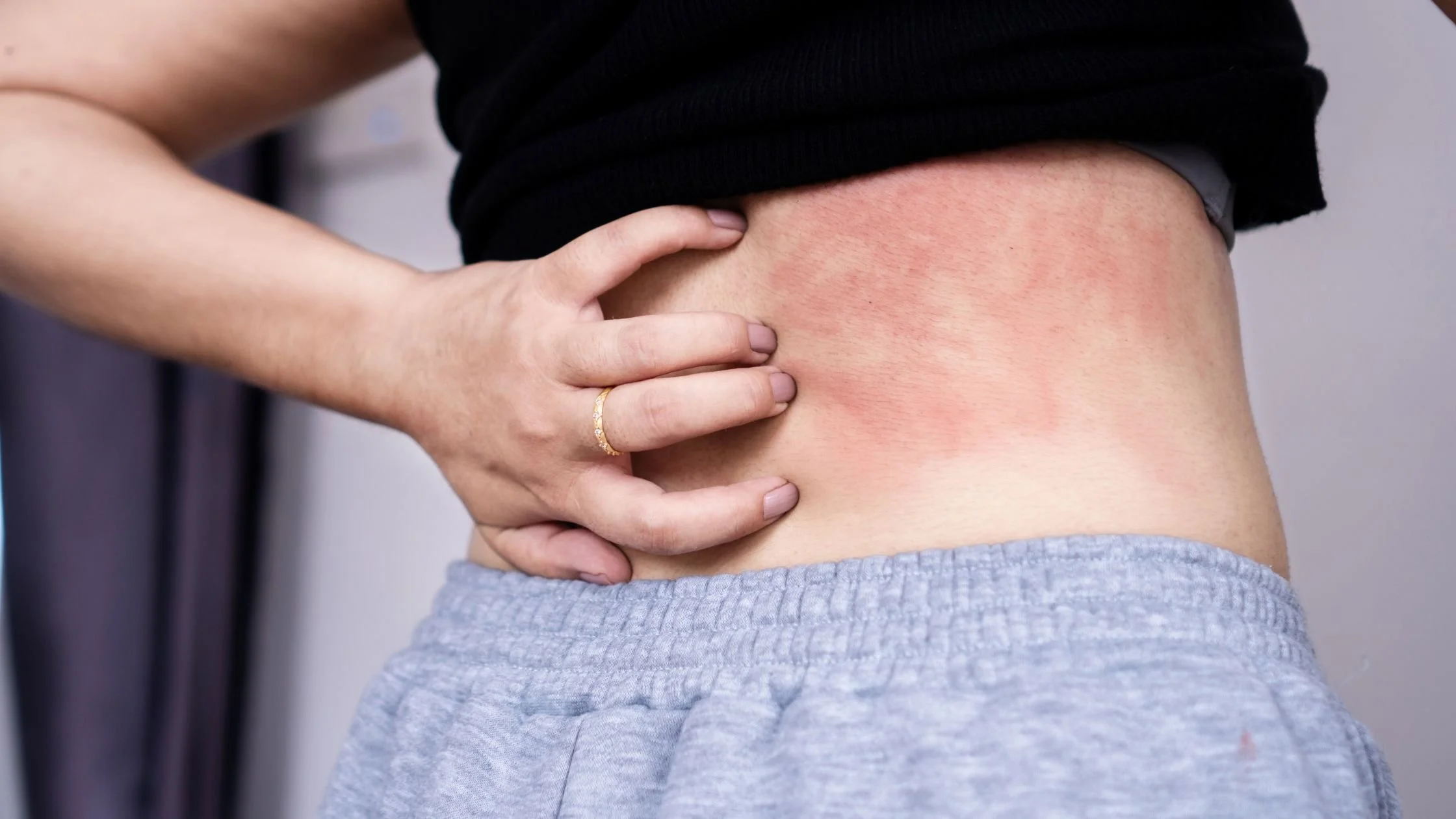 Person scratching red, irritated skin on their lower back