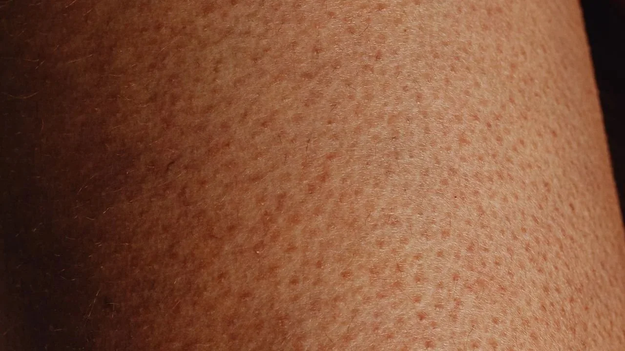 Irritated skin after waxing