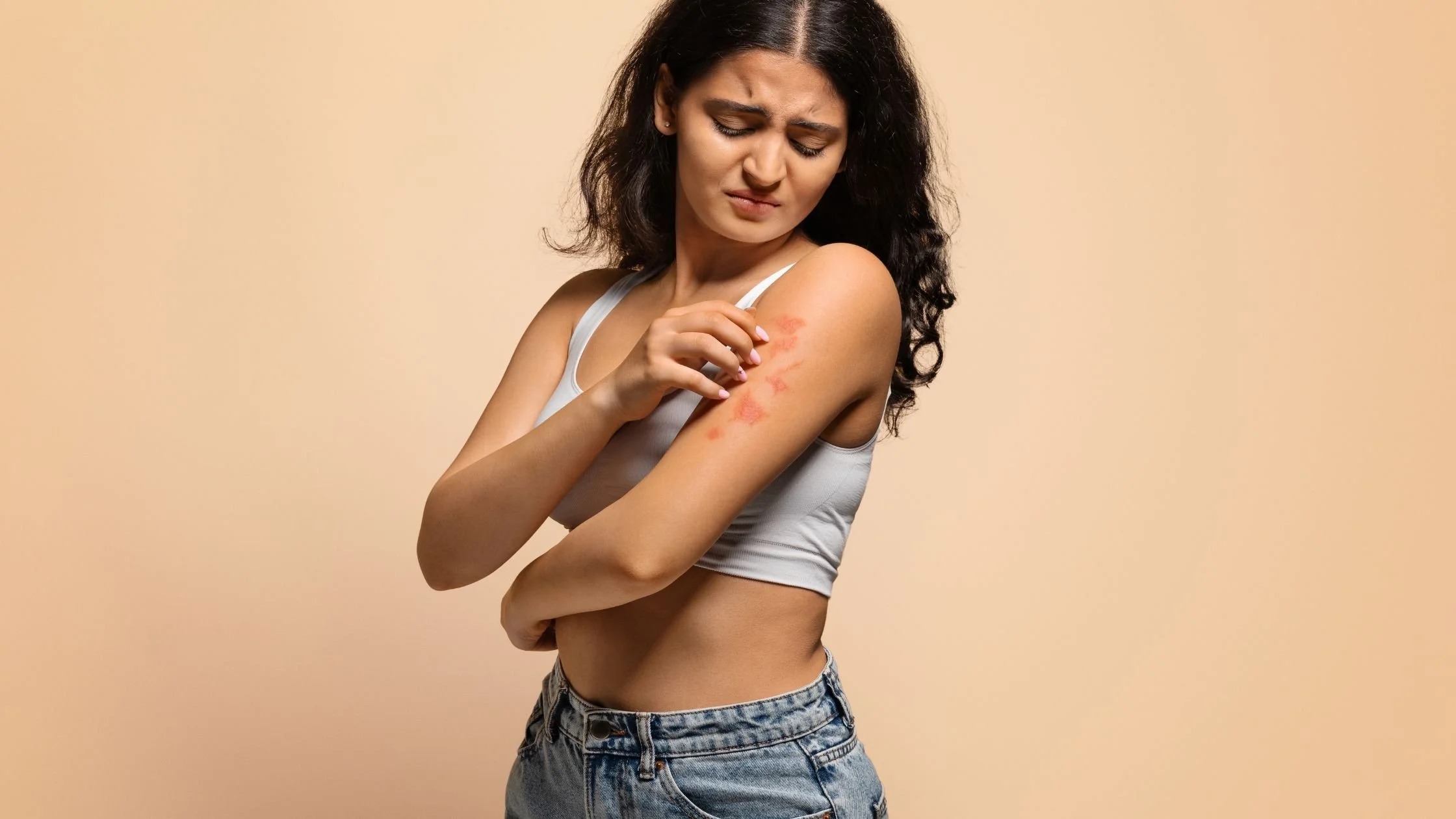 Woman scratching a red rash on her upper arm