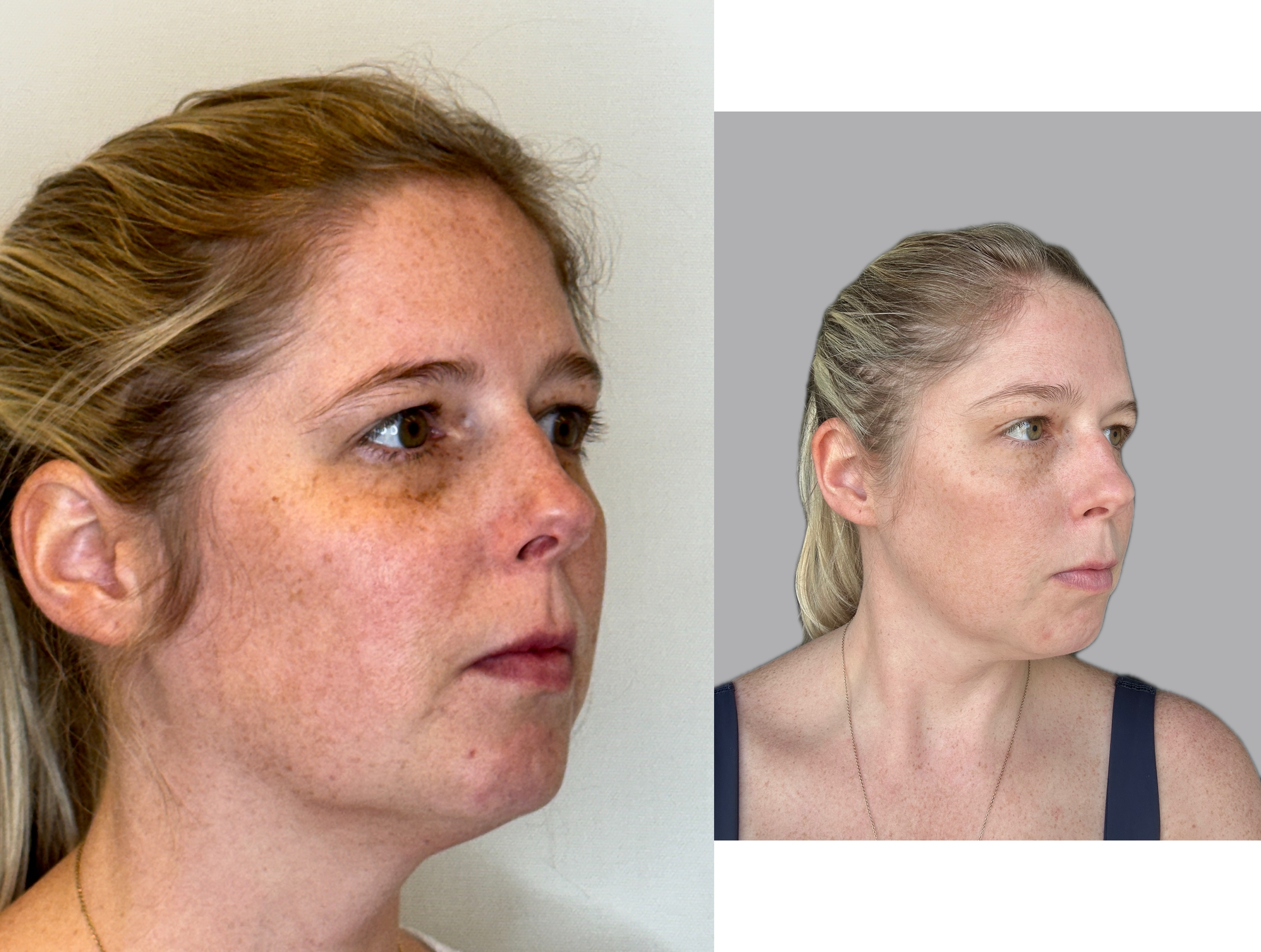 LASER-1 IPL TREATMENT.png