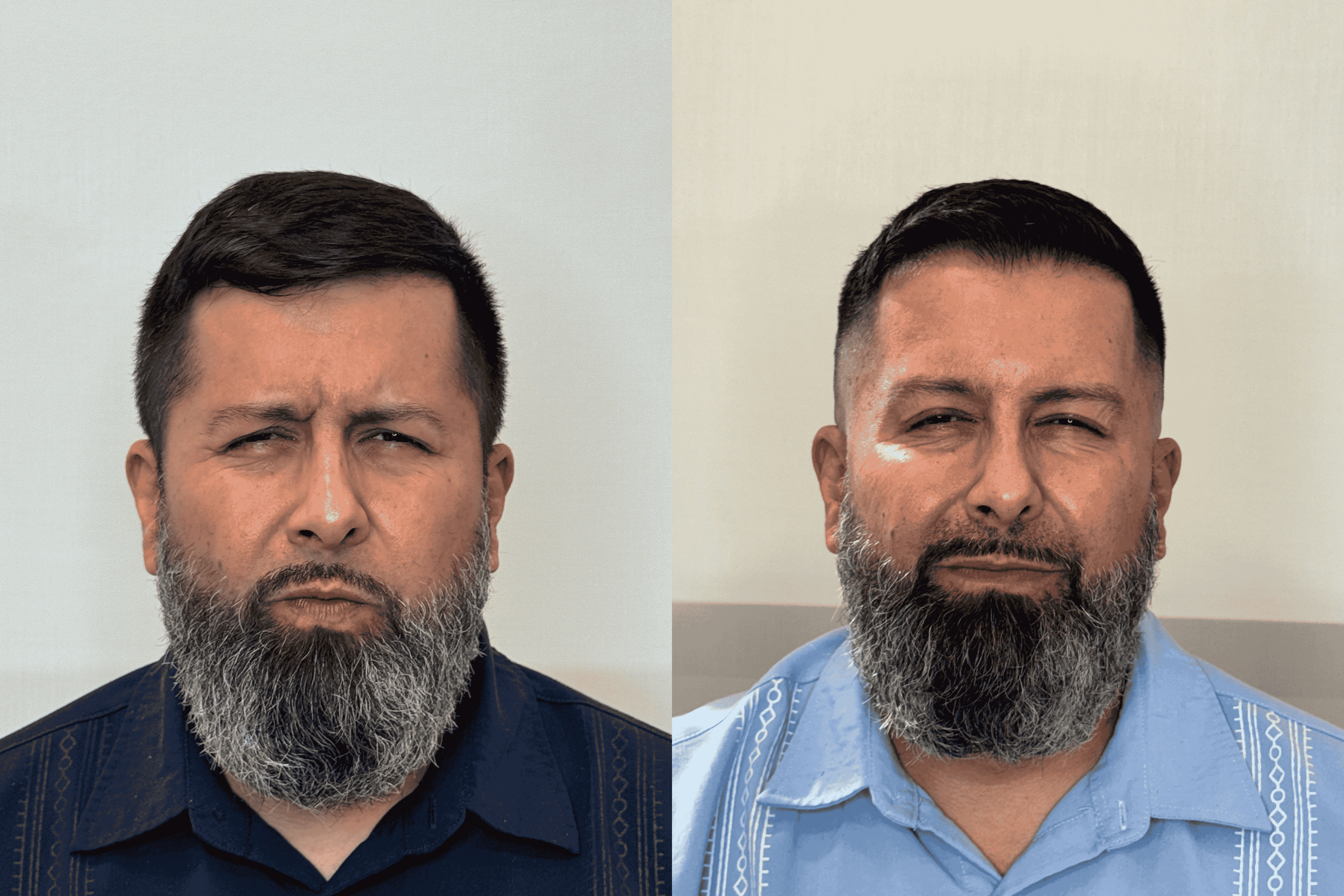 BOTOX GLABELLA RP.png