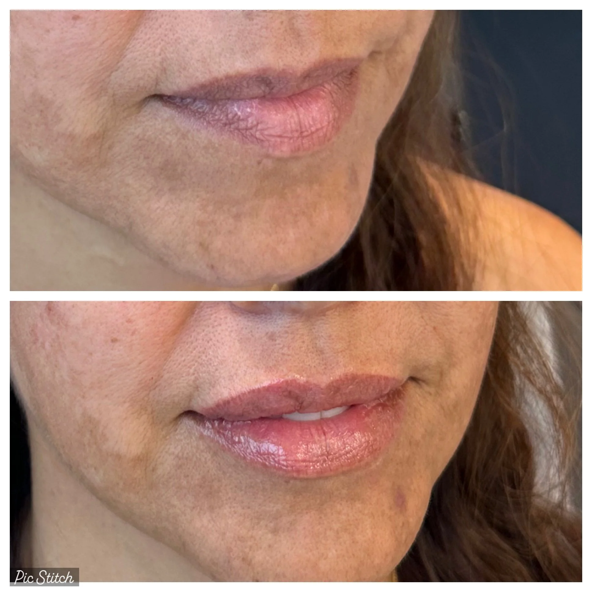 LIP FILLER.JPG