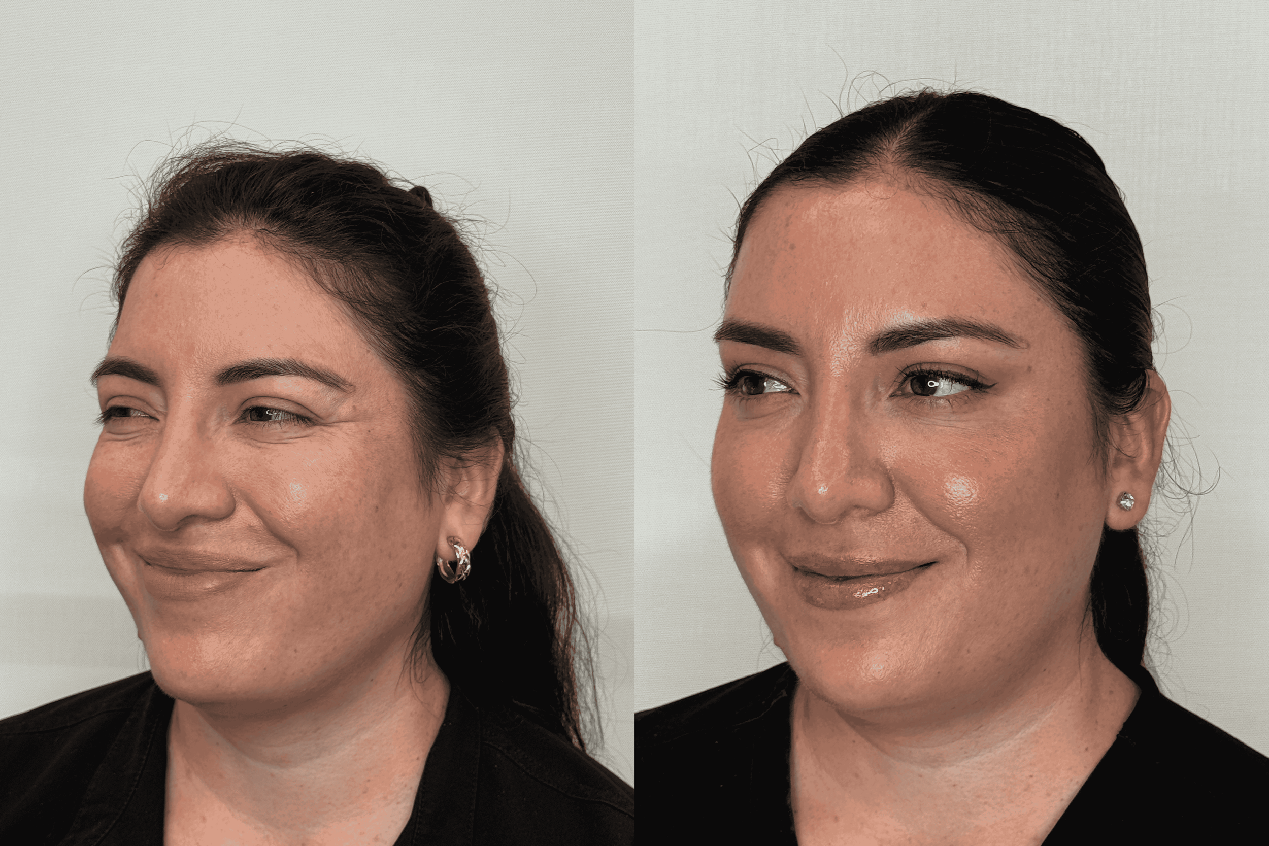 Facial balancing-cheek & crows.png