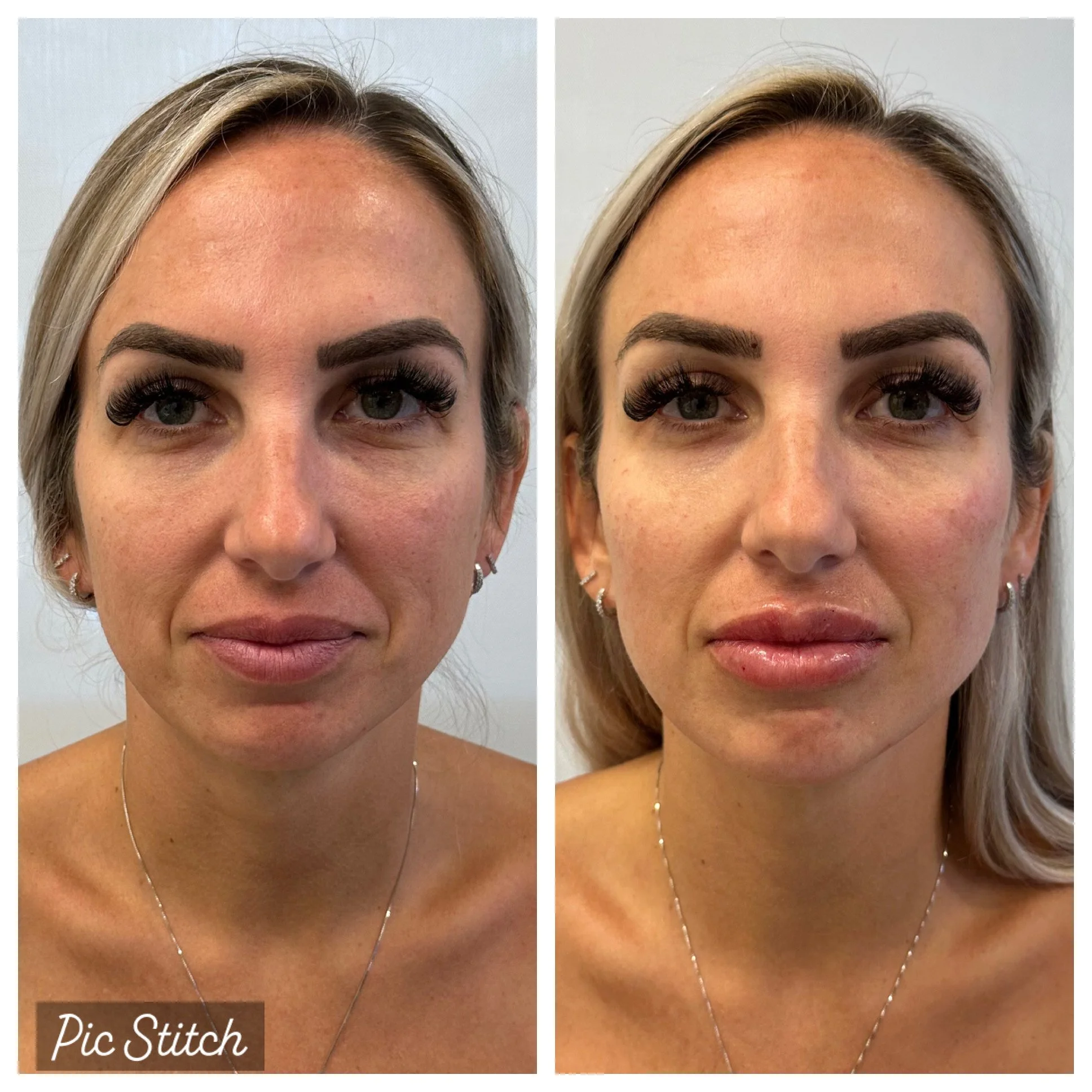 FACIAL BALANCING -FILLER & LIP FILLER.JPG