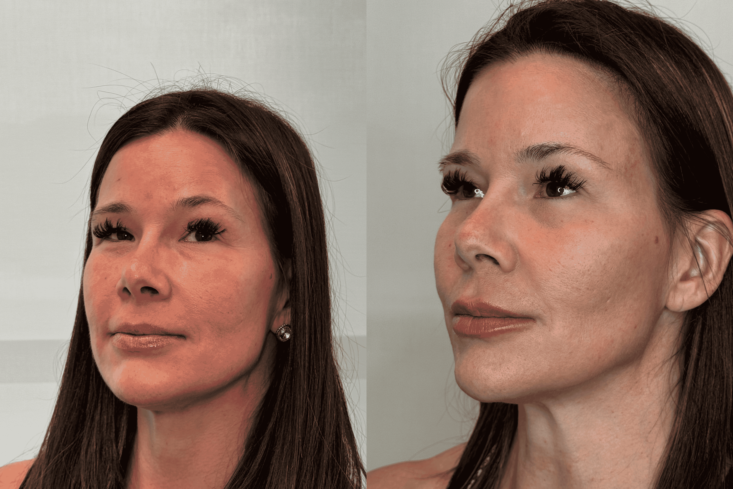 FILLER FACIAL BALANCING 3.png