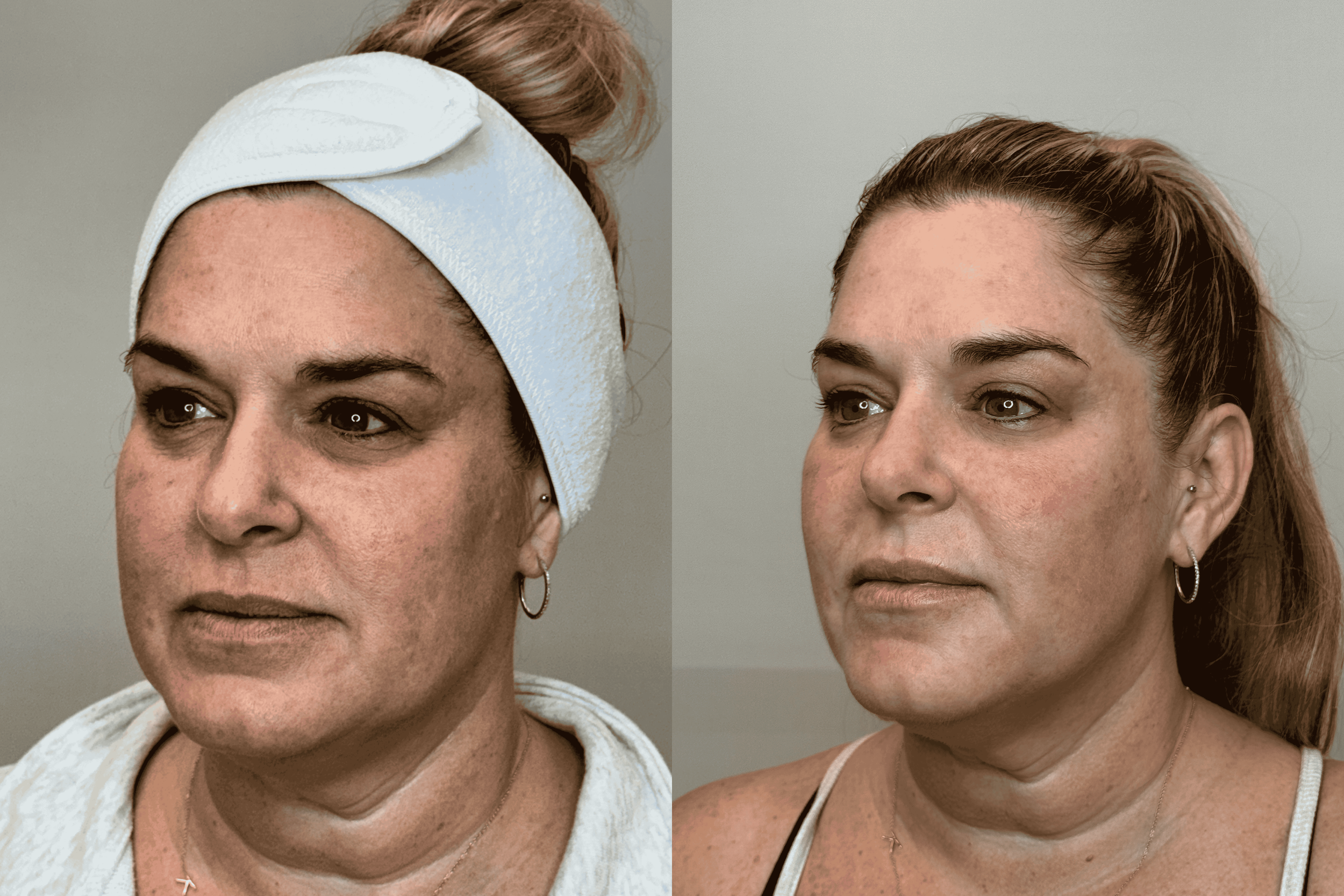 IPL & Laser Before and After — C King Aesthetics