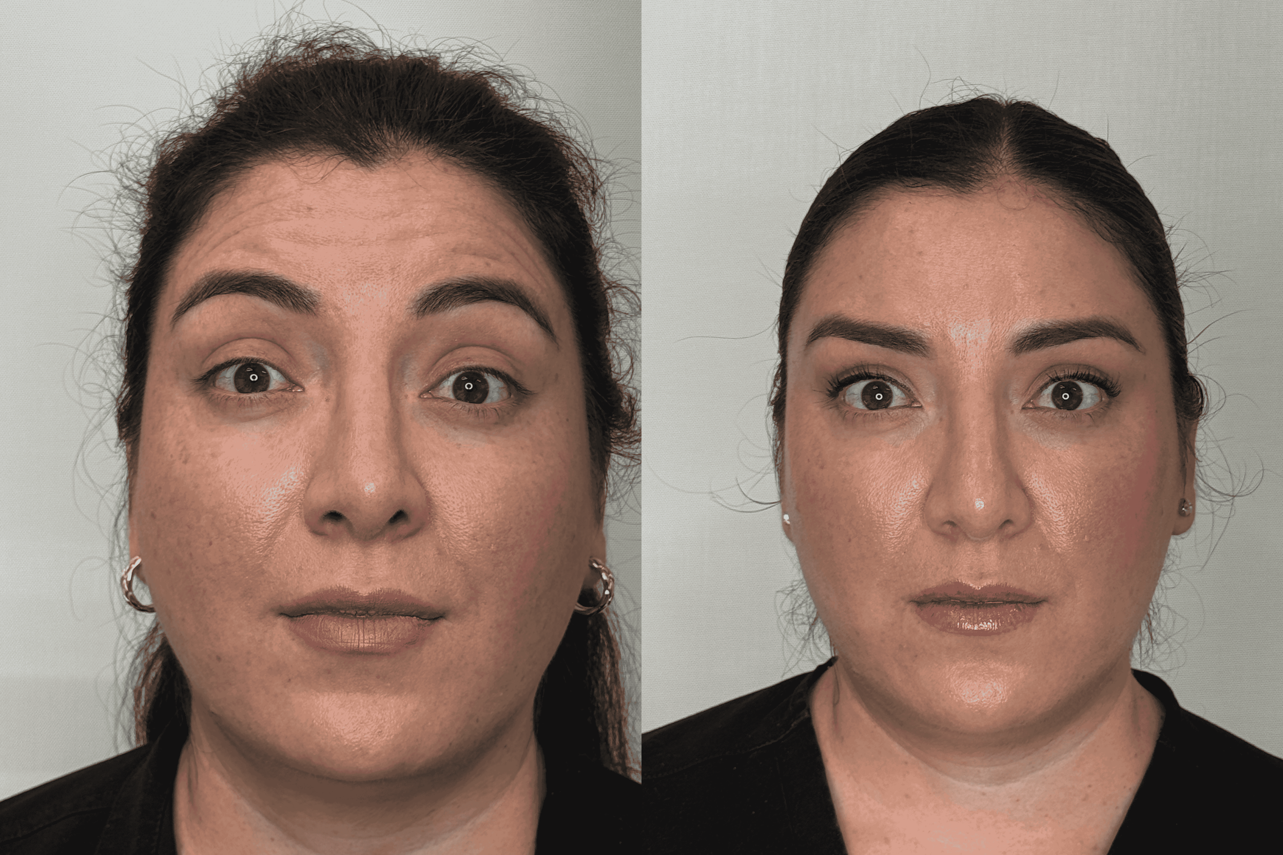 Facial balance-Forhead tox.png