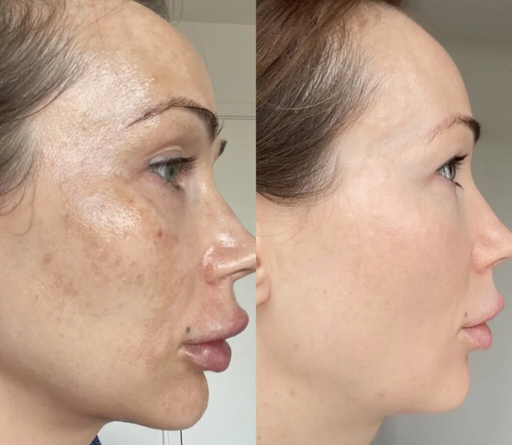 remove-pigmentation-with-Cosmelan-peel-Los-Angeles.jpg