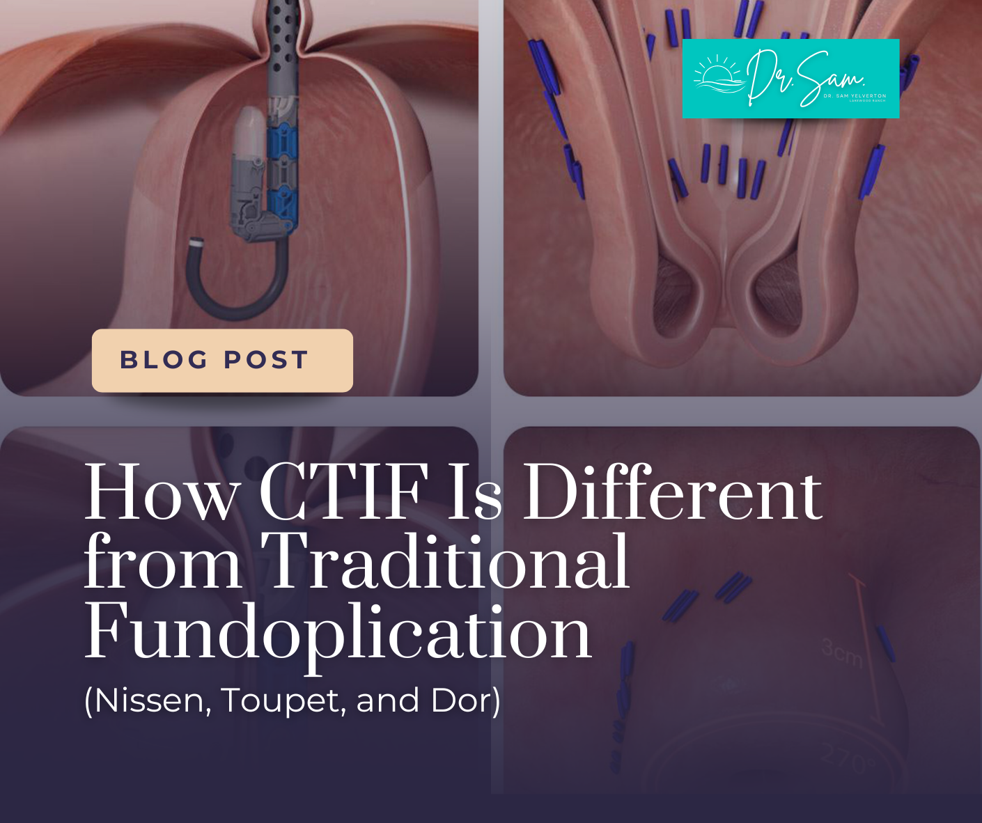How CTIF Is Different from Traditional Fundoplication (Nissen, Toupet, and Dor)