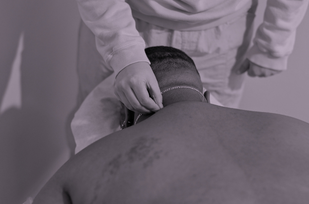 person receiving acupuncture in dumbo brooklyn