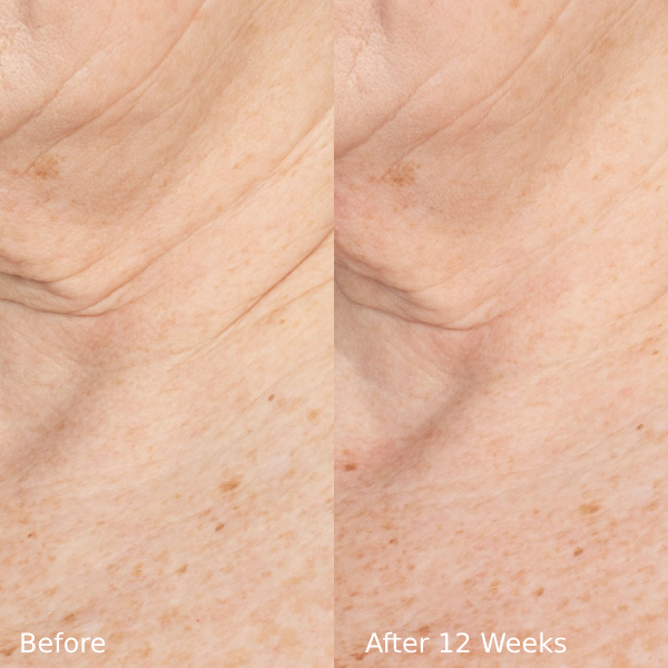 ELADEC60OBA01_ELASTIderm_Neck_Before_After.png
