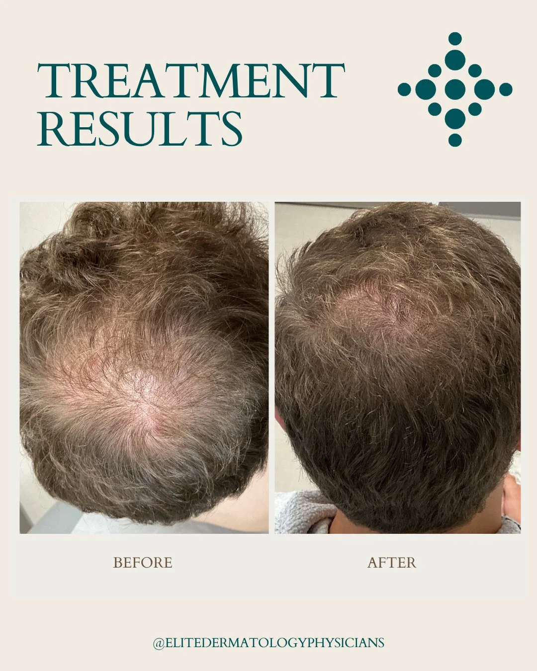 ✨ See the incredible hair transformation of one of our lovely patients! 🌟 After a dedicated journey of consistent treatment for hair growth, we are thrilled to share the stunning results. It’s amazing what a little patience and the right care