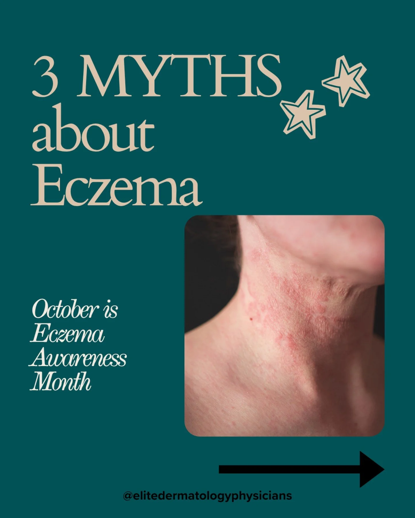 October is Eczema Awareness Month, a perfect time to shed light on a condition that affects millions of people worldwide. Unfortunately, there are many myths surrounding eczema that can lead to misunderstandings and stigma for those who suffer from i