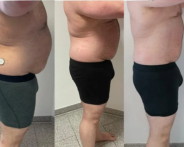 Secuencia de fotos mostrando la pérdida de peso en la zona abdominal y de la espalda de un hombre en diferentes etapas