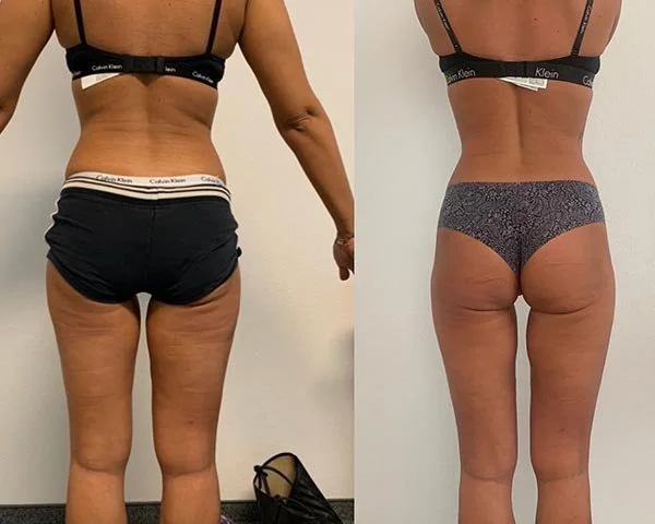 Imagen comparativa del trasero de una mujer antes y después de un cambio corporal, mostrando mejoras en tono y firmeza muscular, usando ropa interior de marca Calvin Klein