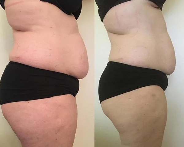 Comparación de abdomen y caderas de una mujer antes y después de un cambio en su peso o salud.