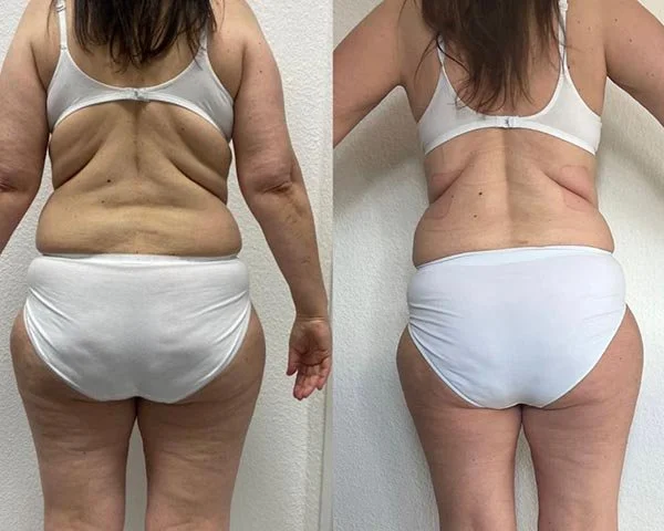 Antes y después de un cambio en la piel y el contorno de la espalda y el abdomen de una mujer