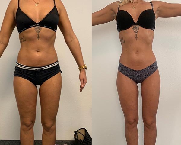 Comparación del antes y después de una transformación corporal, mostrando reducción de grasa y tonificación muscular en abdomen, brazos y piernas.