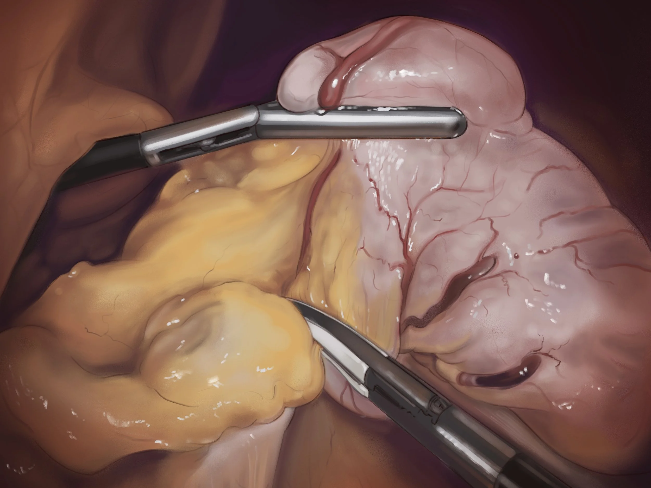 Study from a laparascopic sleeve gastrectomy (Procreate) (2026)