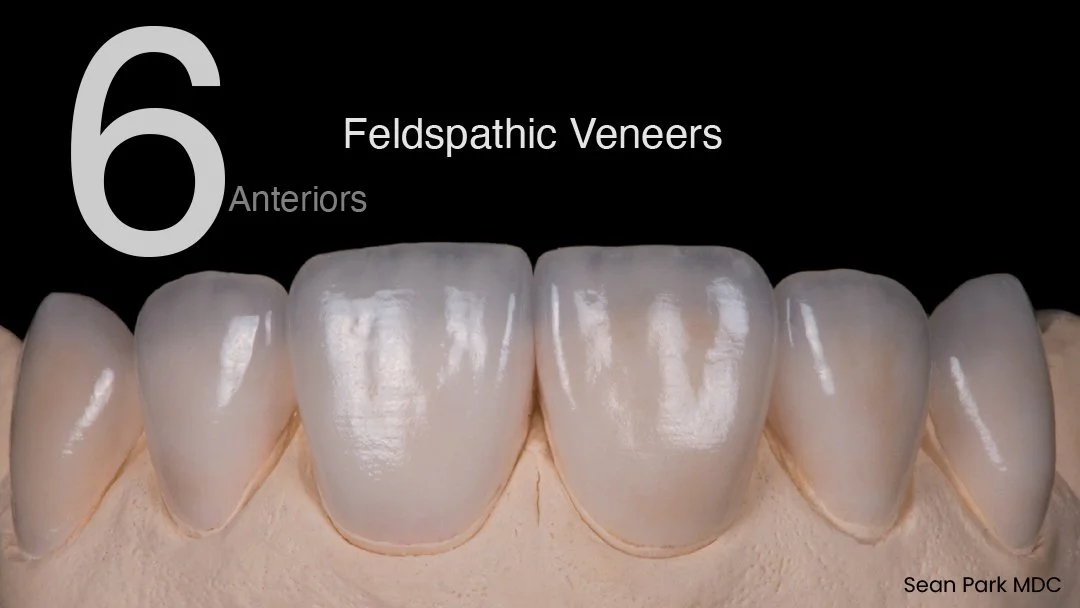 #6&ndash;11 Feldspathic veneers.
Minimally invasive. Timeless esthetics.
Feldspathic still stands as one of the best options.
Happy New Year!
#Feldspathic #veneers #ThinVeneers