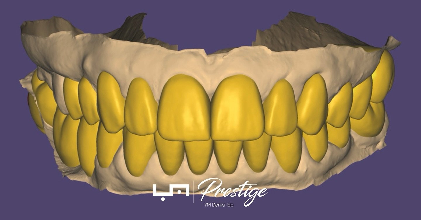 Daily design case at YM Prestige. Upper and lower digital diagnostic wax-up completed with smile creator ! 

info@ymprestige.com

#ymdentallab #ymprestige #amanngirrbach
#exocad #exocadofficial #digitaldentistry #smiledesign #esthetic #ymdentallab #t