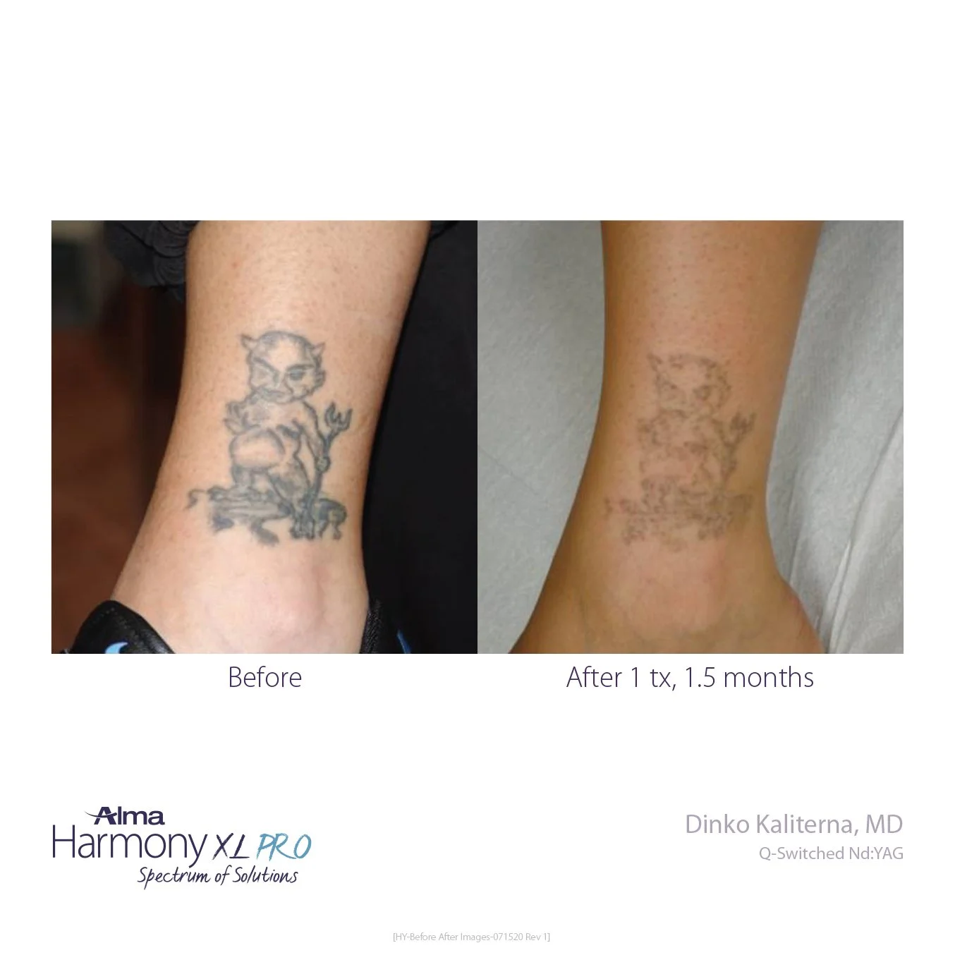 Tatto Removal Willow Bend MedicalHY-Before-and-After-B2C-12.jpg