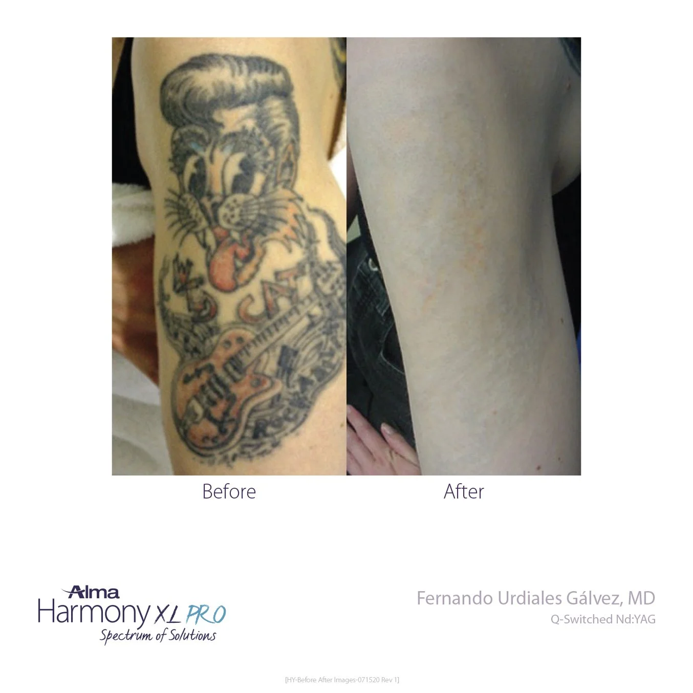 Tatto Removal Willow Bend MedicalHY-Before-and-After-B2C-11.jpg