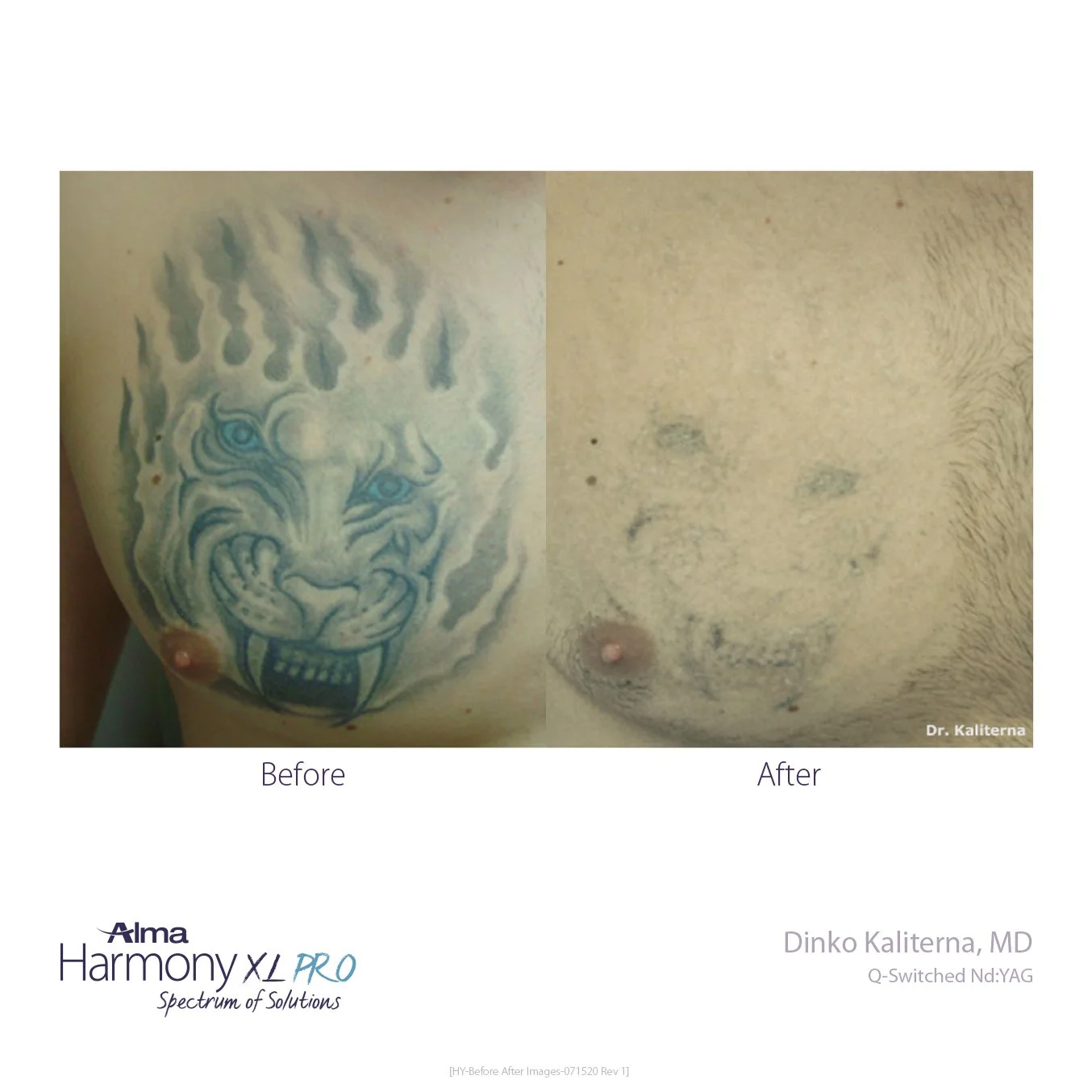 Tatto Removal Willow Bend MedicalHY-Before-and-After-B2C-13.jpg