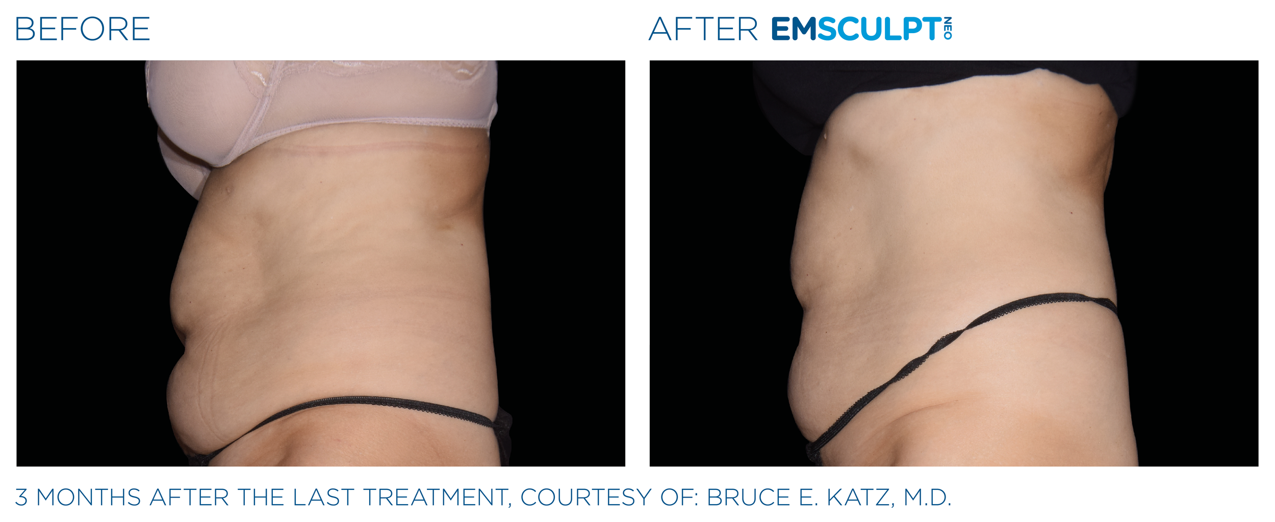 AbdomenEmsculpt_neo_PIC_Ba-card-female-abdomen-003_ENUS100.png