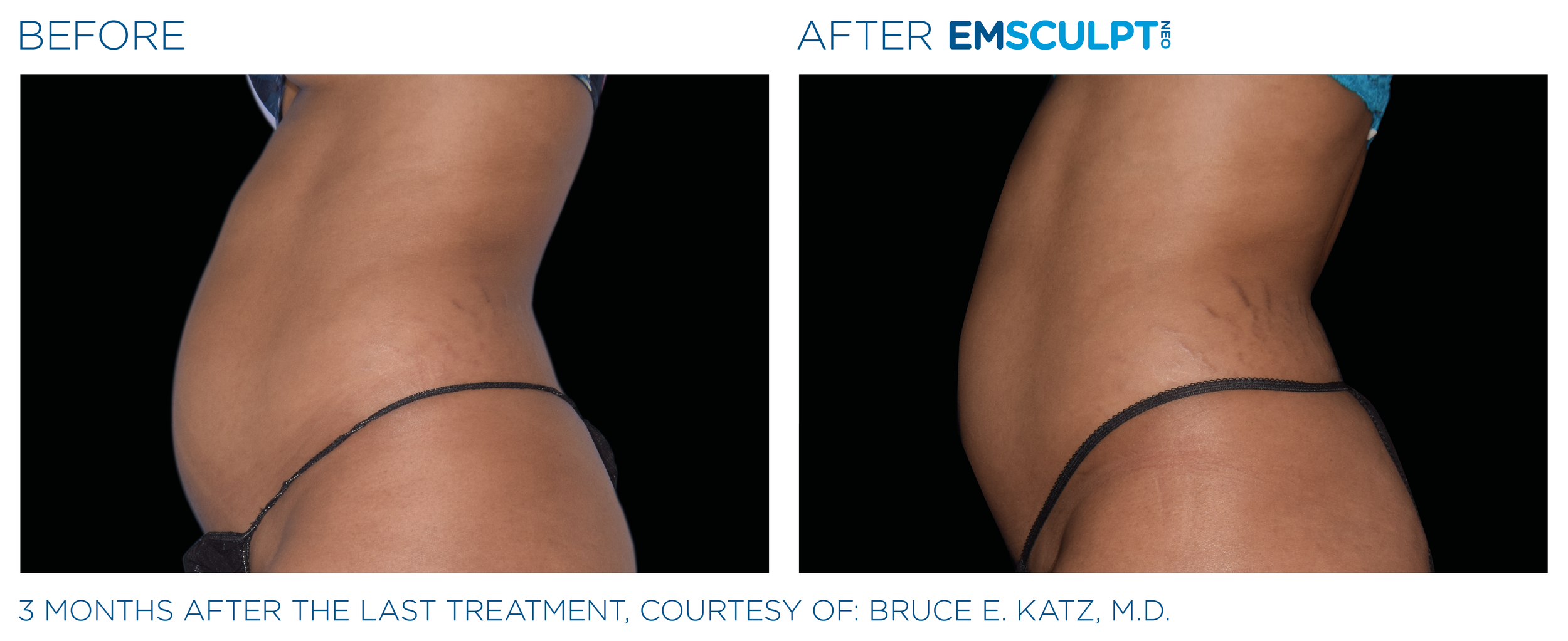 AbdomenEmsculpt_neo_PIC_Ba-card-female-abdomen-004_ENUS100.png