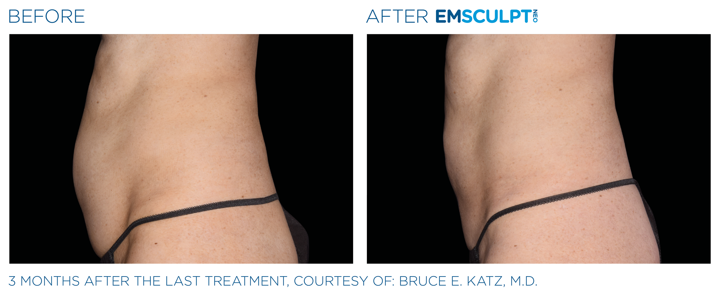 AbdomenEmsculpt_neo_PIC_Ba-card-female-abdomen-006_ENUS100.png