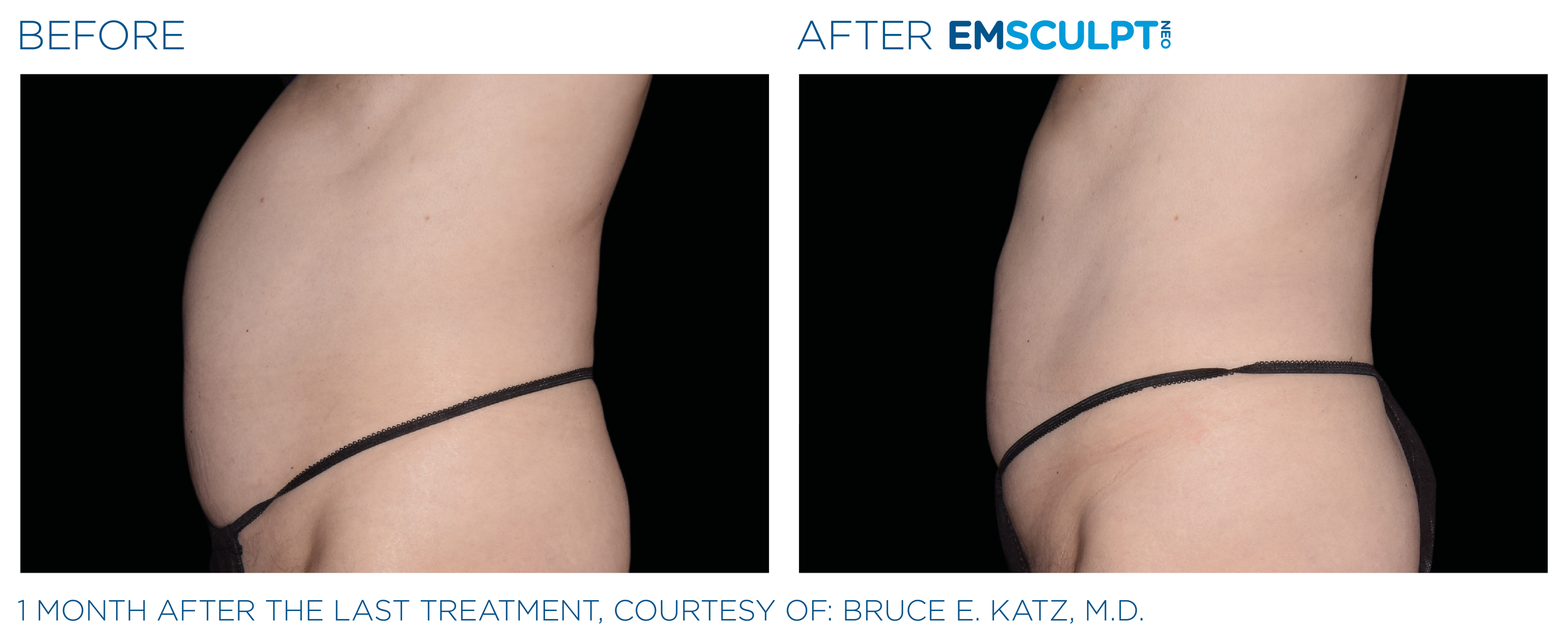 AbdomenEmsculpt_neo_PIC_Ba-card-female-abdomen-008_ENUS100.png