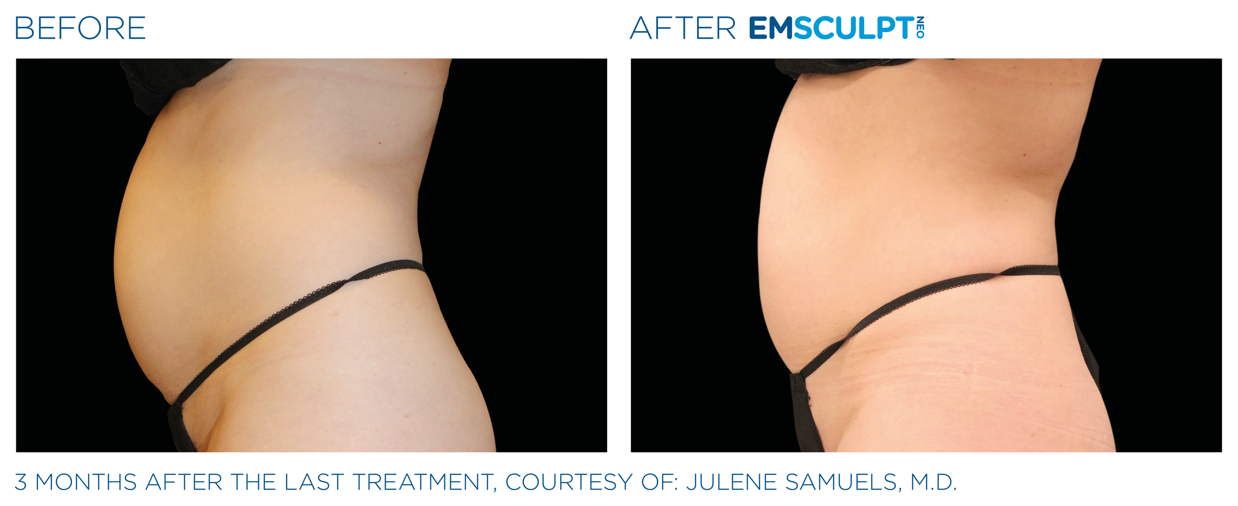 AbdomenEmsculpt_neo_PIC_Ba-card-female-abdomen-007_ENUS100.png