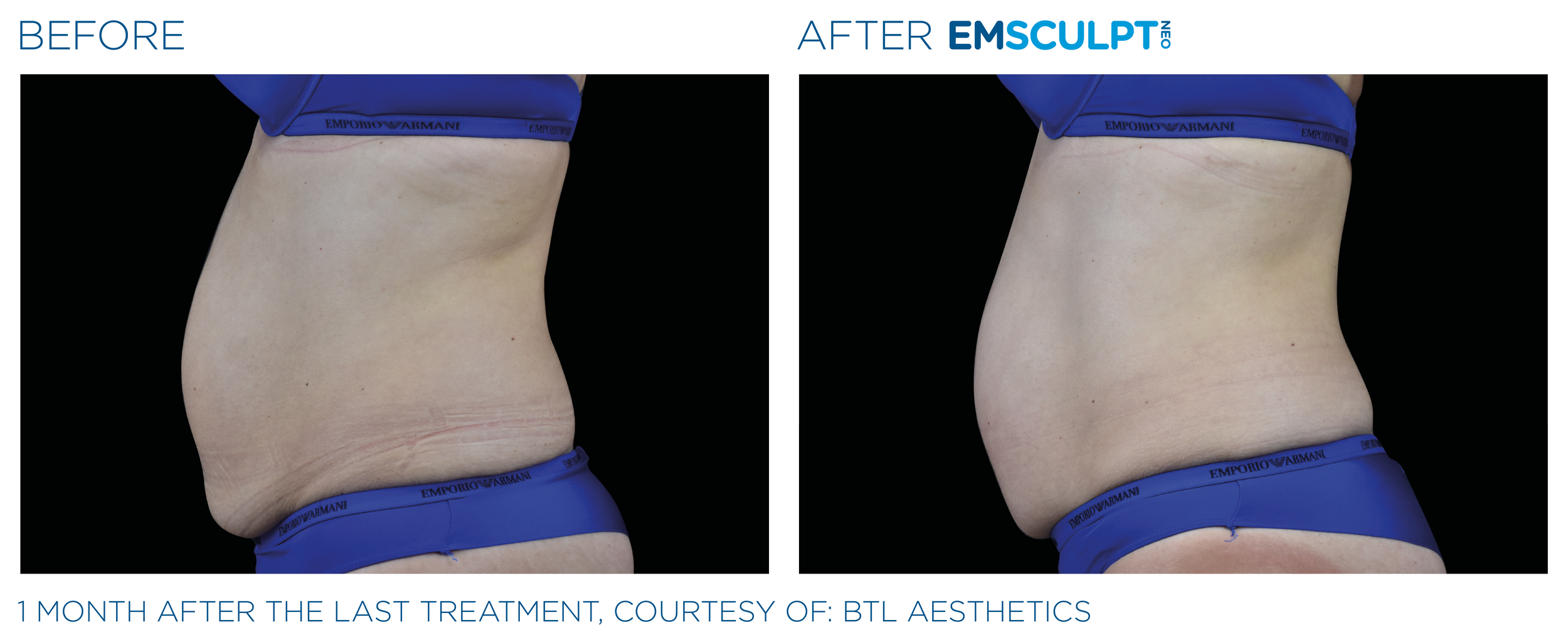 AbdomenEmsculpt_neo_PIC_Ba-card-female-abdomen-011_ENUS100.png