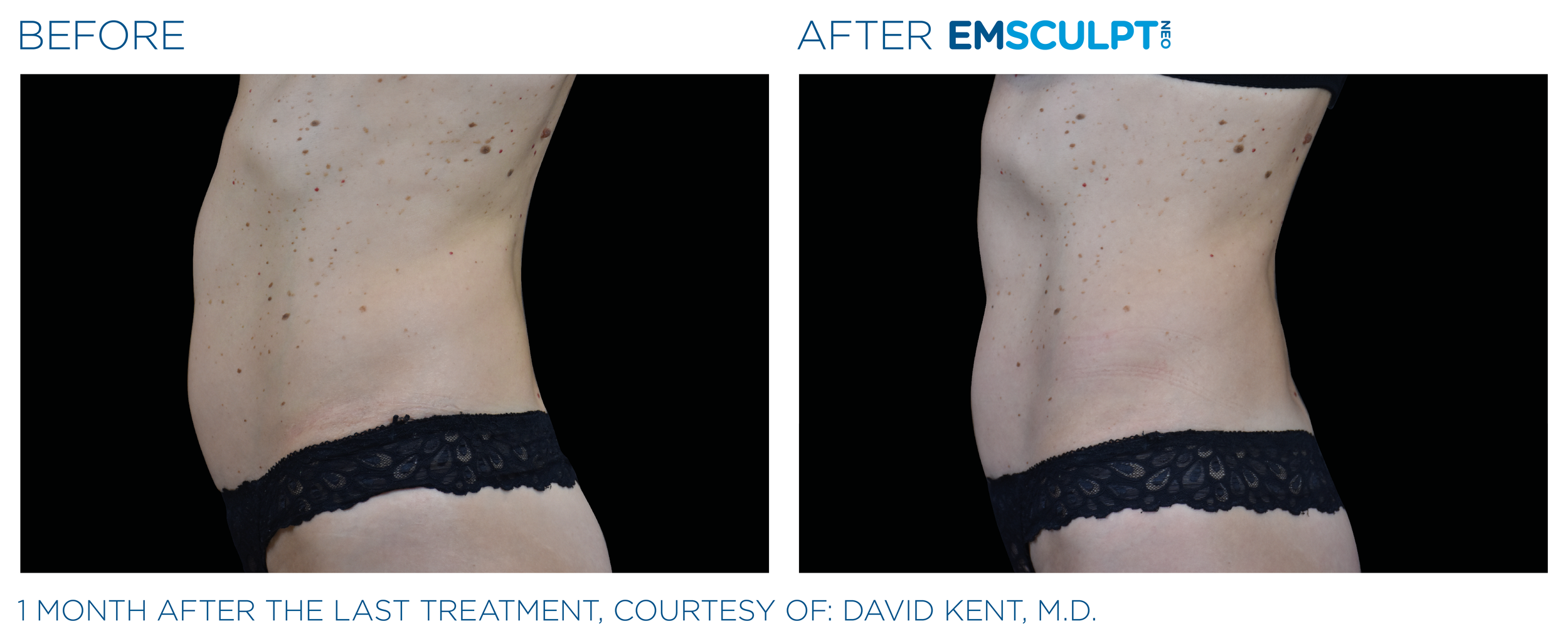AbdomenEmsculpt_neo_PIC_Ba-card-female-abdomen-015_ENUS100.png