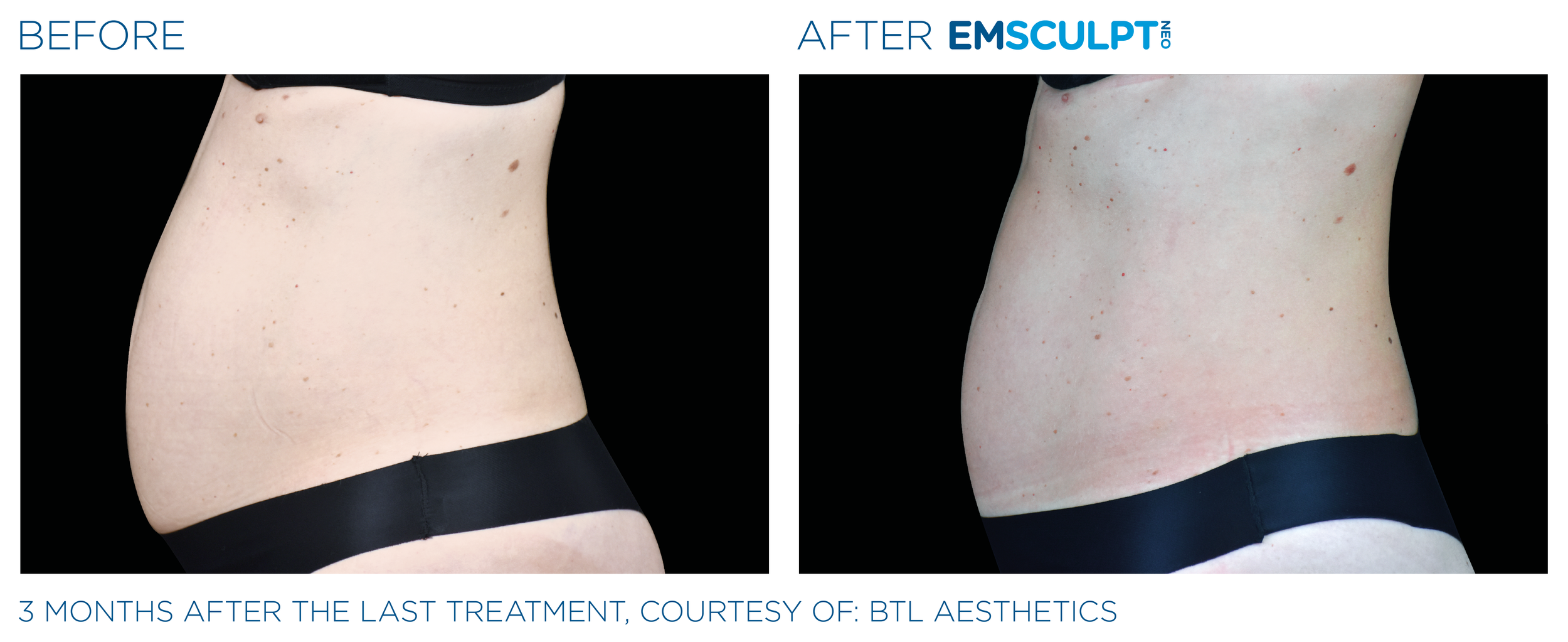 AbdomenEmsculpt_neo_PIC_Ba-card-female-abdomen-016_ENUS100.png