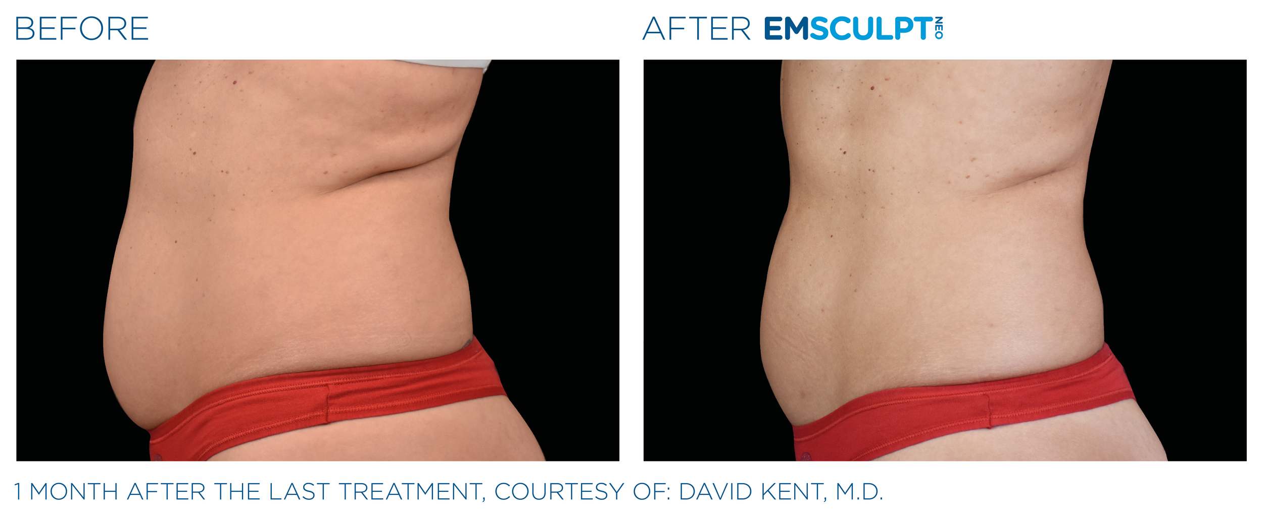 AbdomenEmsculpt_neo_PIC_Ba-card-female-abdomen-017_ENUS100.png