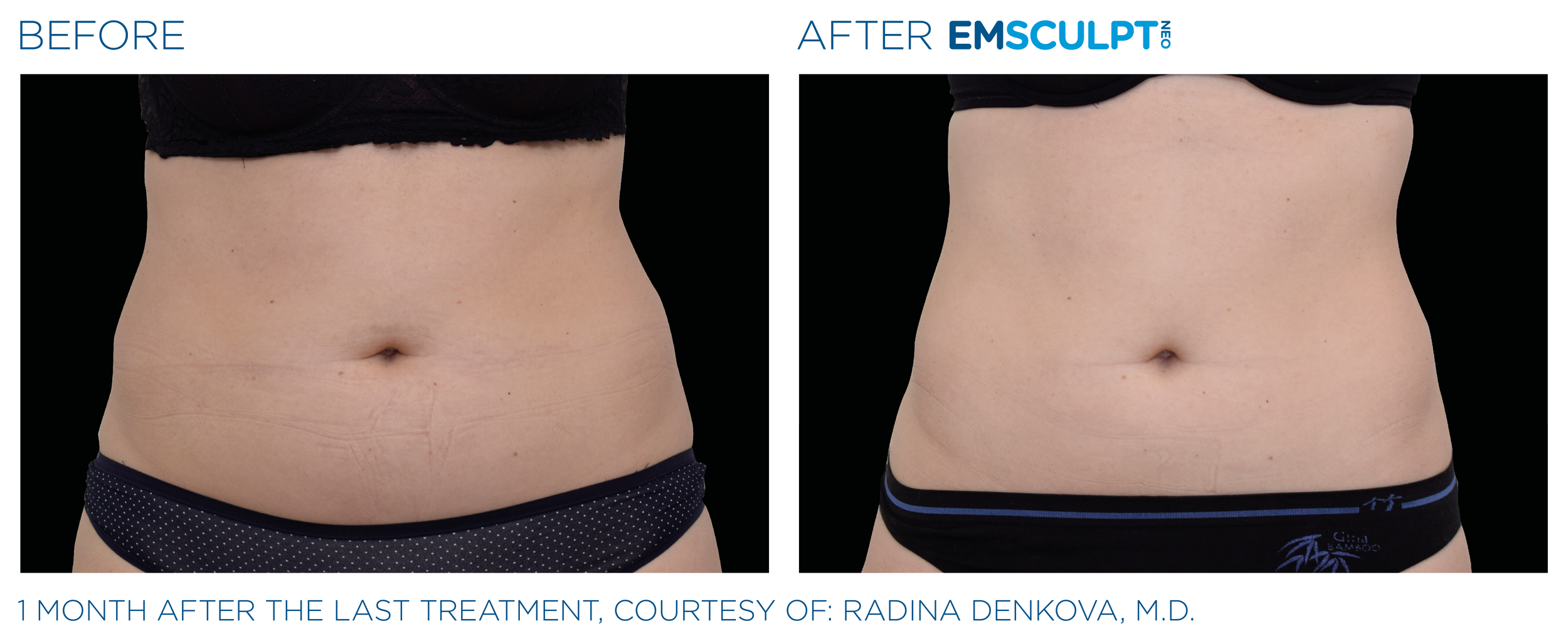 AbdomenEmsculpt_neo_PIC_Ba-card-female-abdomen-019_ENUS100.png