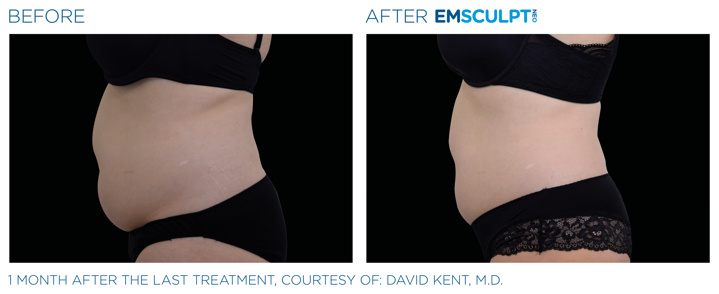 AbdomenEmsculpt_neo_PIC_Ba-card-female-abdomen-020_ENUS100.png