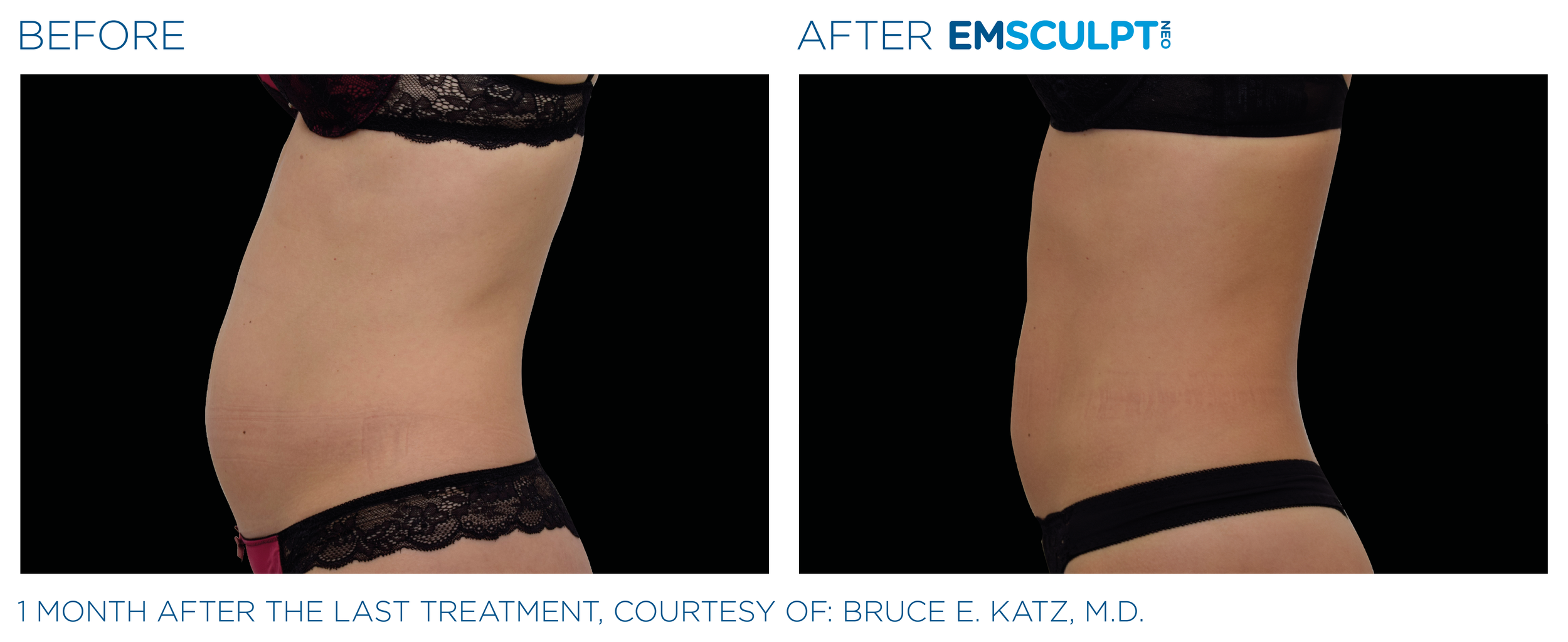 AbdomenEmsculpt_neo_PIC_Ba-card-female-abdomen-023_ENUS100.png
