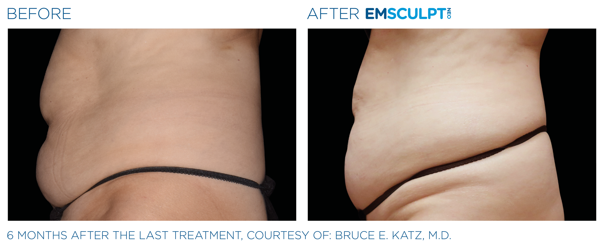AbdomenEmsculpt_neo_PIC_Ba-card-female-abdomen-031_ENUS100.png