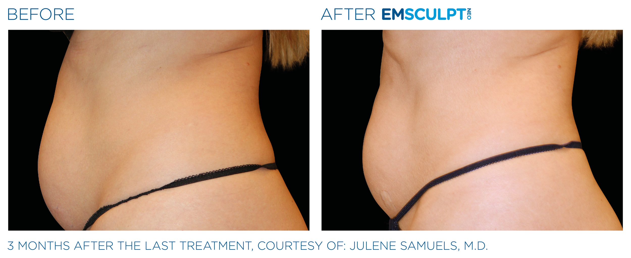 AbdomenEmsculpt_neo_PIC_Ba-card-female-abdomen-032_ENUS100.png
