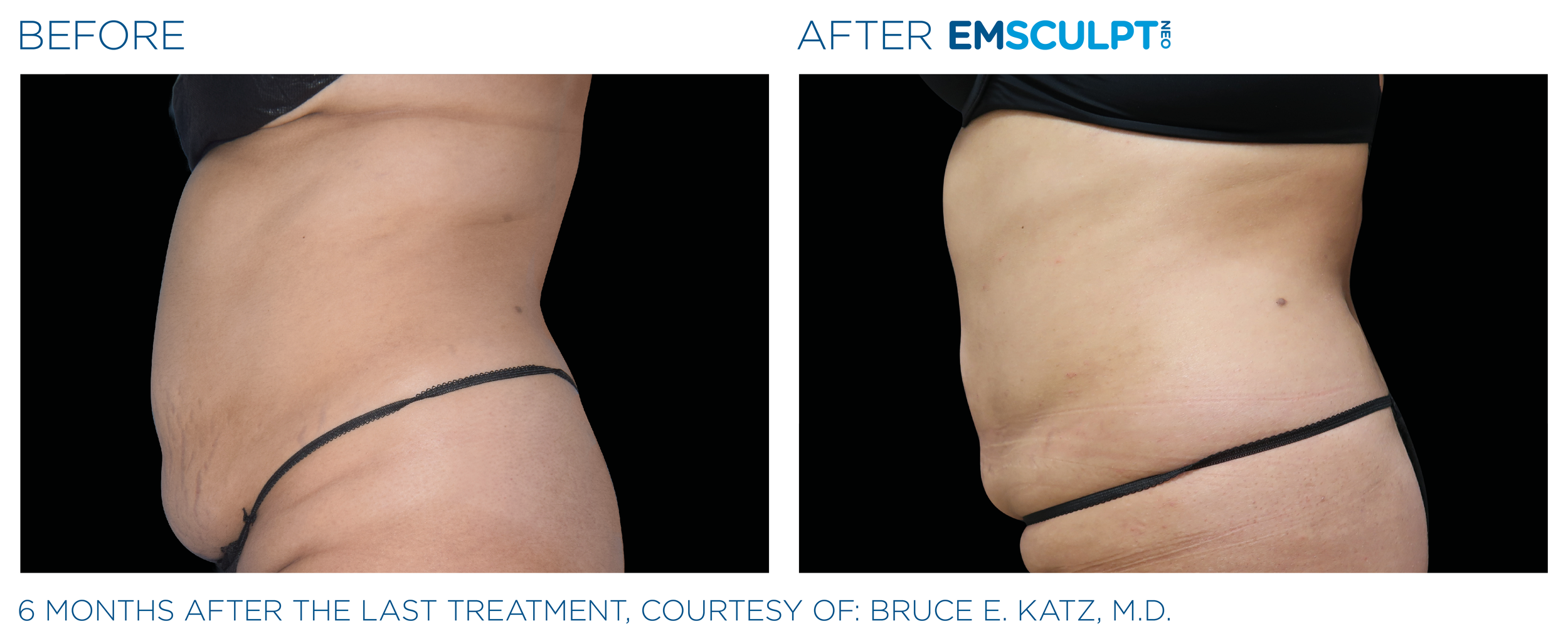 AbdomenEmsculpt_neo_PIC_Ba-card-female-abdomen-033_ENUS100.png
