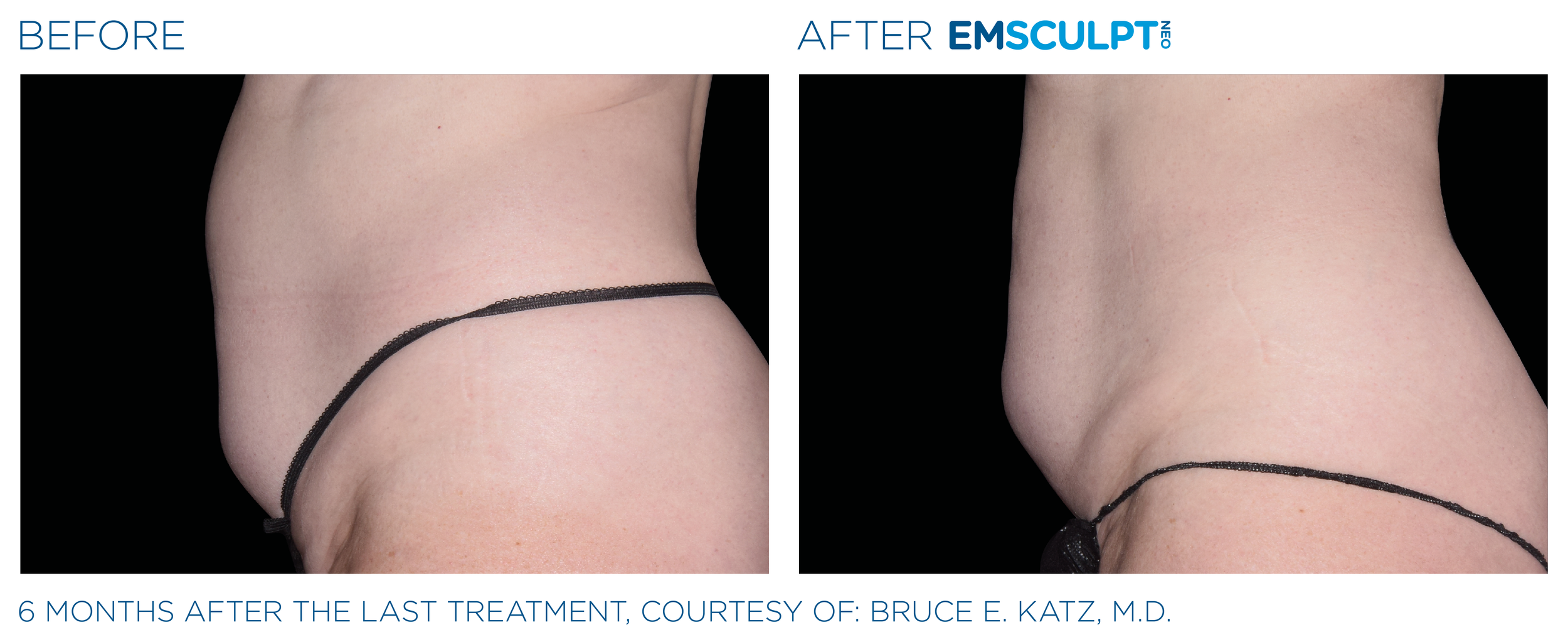 AbdomenEmsculpt_neo_PIC_Ba-card-female-abdomen-036_ENUS100.png