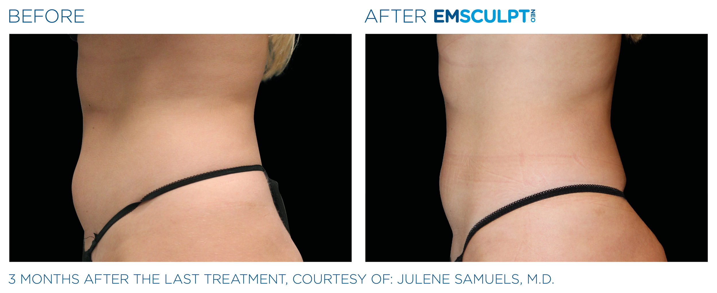 AbdomenEmsculpt_neo_PIC_Ba-card-female-abdomen-034_ENUS100.png