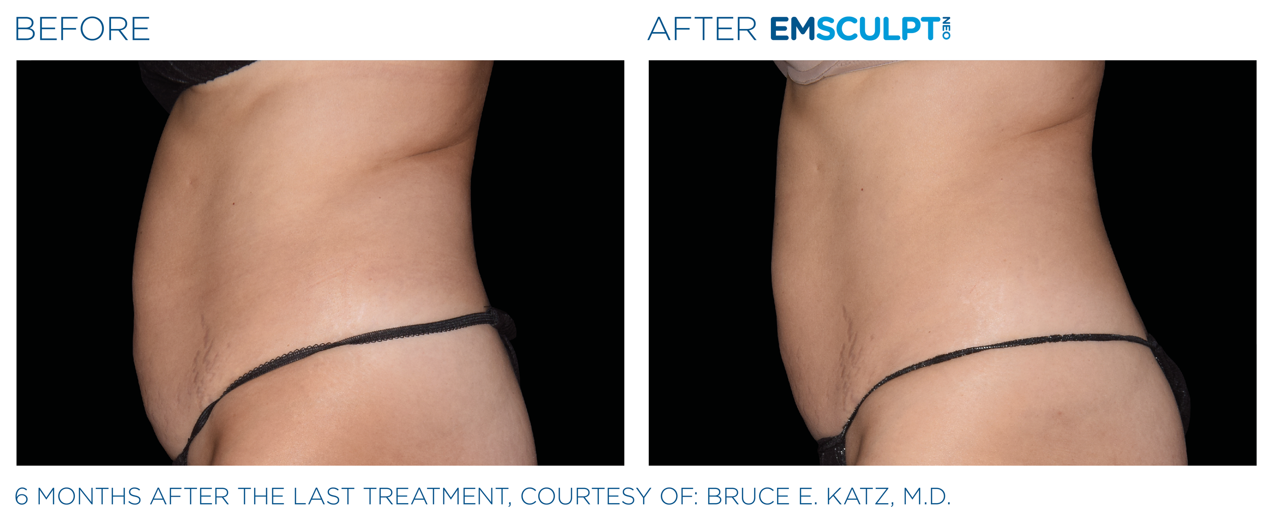 AbdomenEmsculpt_neo_PIC_Ba-card-female-abdomen-037_ENUS100.png