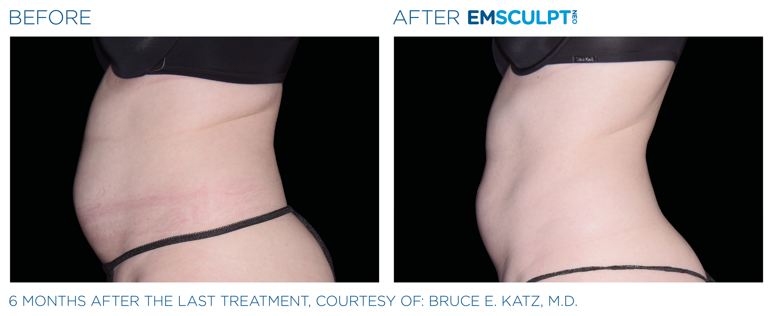 AbdomenEmsculpt_neo_PIC_Ba-card-female-abdomen-038_ENUS100.png