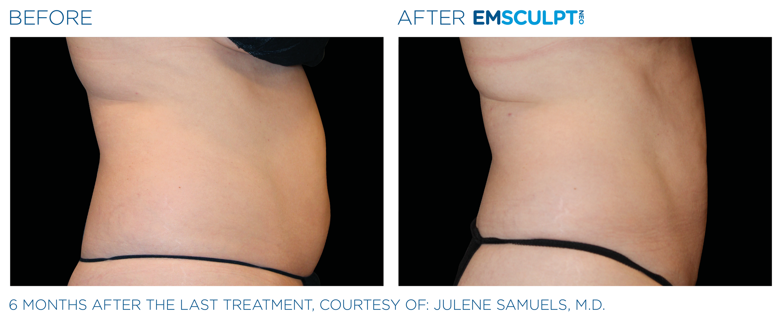 AbdomenEmsculpt_neo_PIC_Ba-card-female-abdomen-040_ENUS100.png